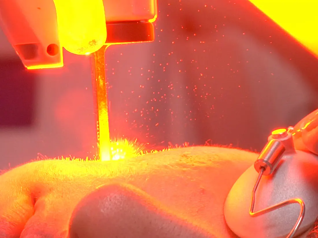 En laserbehandling af en næse set tæt på, med en kraftig orange lysstråle fra et håndstykke mod huden.